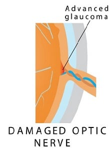eye condition caused by damage to the optic nerve